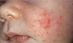 شیوع «سرخک» در عراق/ ضرورت کامل کردن سابقه واکسیناسیون کودکان