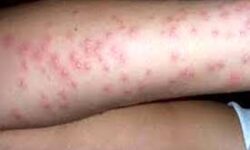 تب مالت با این خوراکی‌ها به سراغتان می‌آید