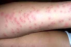 تب مالت با این خوراکی‌ها به سراغتان می‌آید