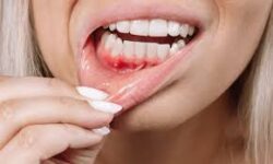 شیوع بالای انگلهای دهانی در بیماران دیابتی